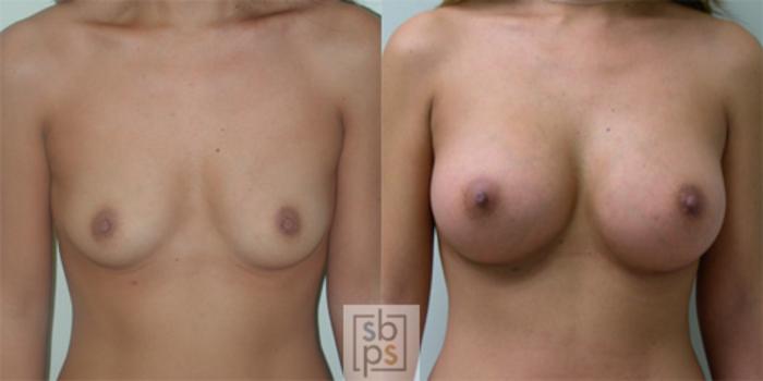 Before & After Breast Augmentation Case 35 View #2 View in Torrance, CA