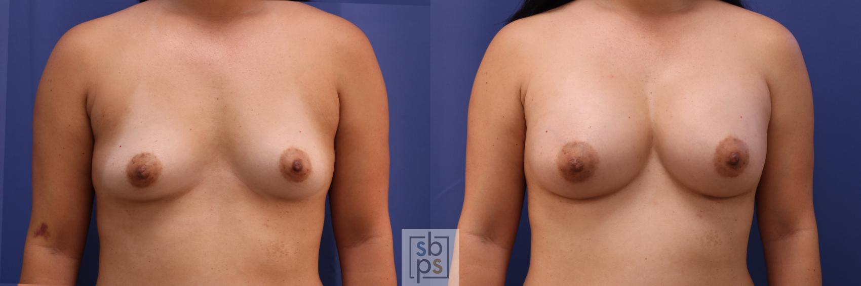 Before & After Breast Augmentation Case 350 View #1 View in Torrance, CA
