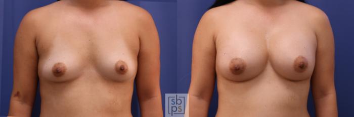 Before & After Breast Augmentation Case 350 View #1 View in Torrance, CA