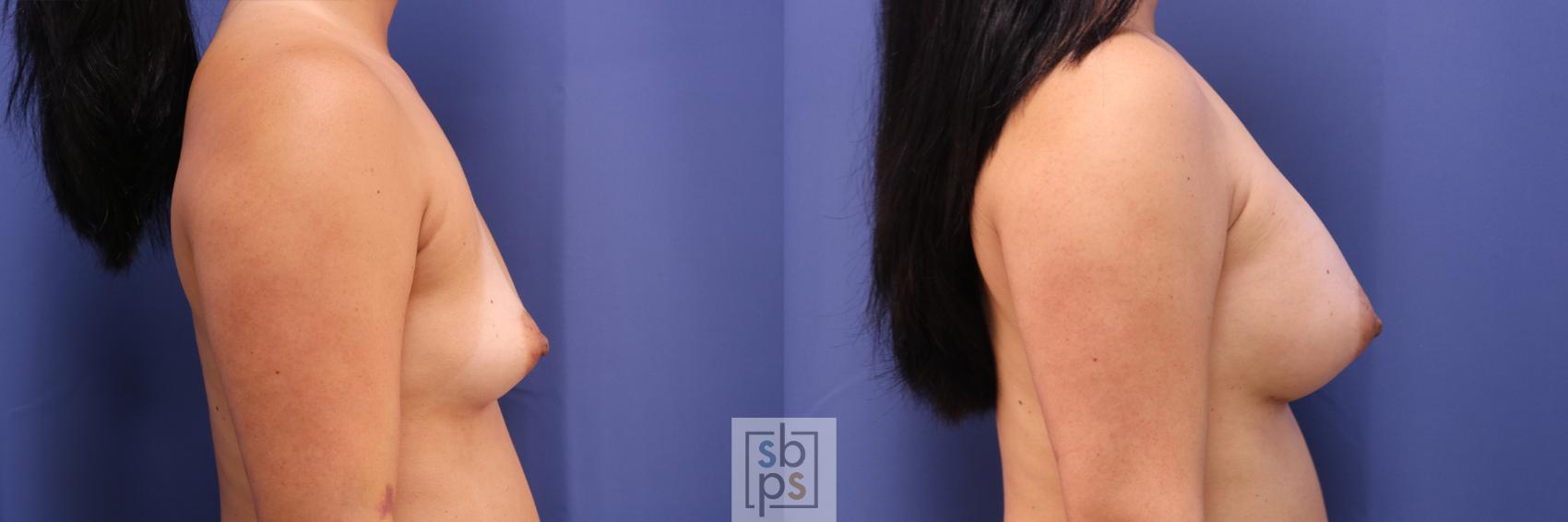Before & After Breast Augmentation Case 350 View #4 View in Torrance & Los Angeles, CA, CA