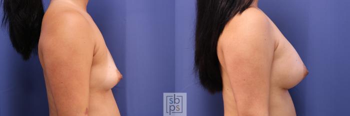 Before & After Breast Augmentation Case 350 View #4 View in Torrance, CA