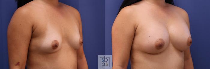 Before & After Breast Augmentation Case 350 View #5 View in Torrance, CA