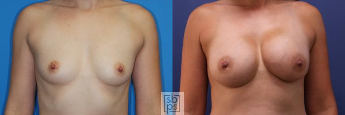Before & After Breast Augmentation Case 352 View #1 View in Torrance, CA