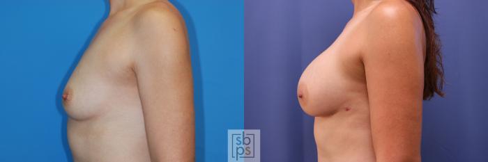 Before & After Breast Augmentation Case 352 View #2 View in Torrance, CA