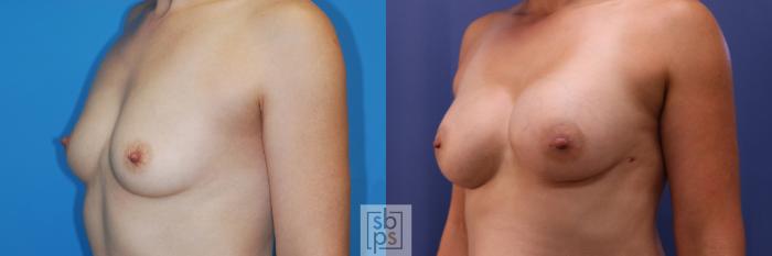 Before & After Breast Augmentation Case 352 View #3 View in Torrance, CA