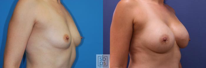 Before & After Breast Augmentation Case 352 View #5 View in Torrance, CA