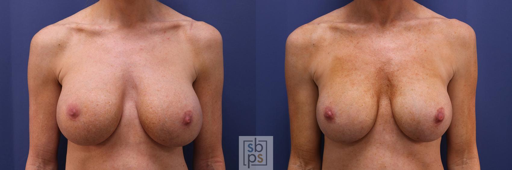 Before & After Breast Augmentation Case 355 View #1 View in Torrance, CA