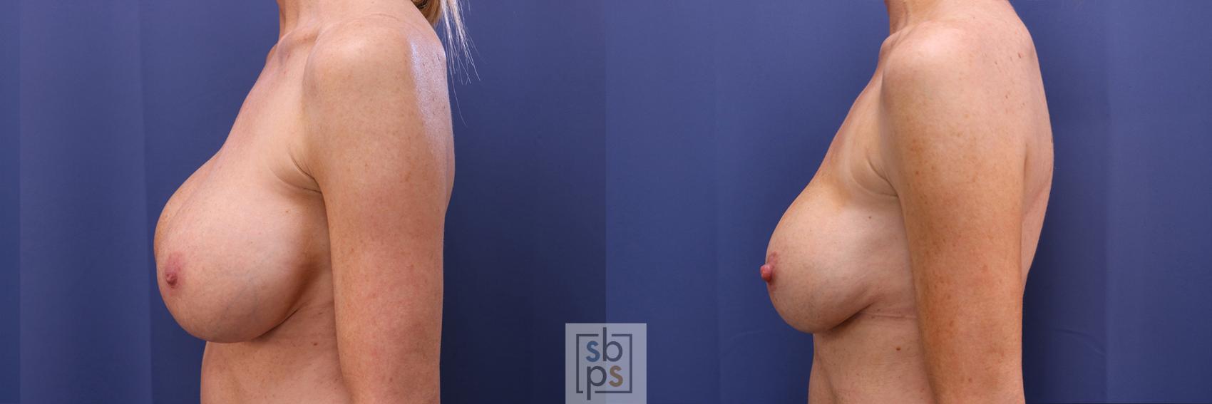 Before & After Breast Augmentation Case 355 View #2 View in Torrance & Los Angeles, CA, CA