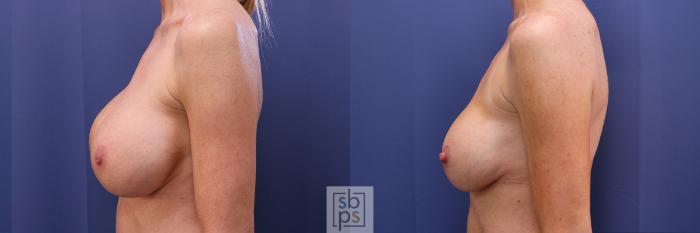 Before & After Breast Augmentation Case 355 View #2 View in Torrance, CA