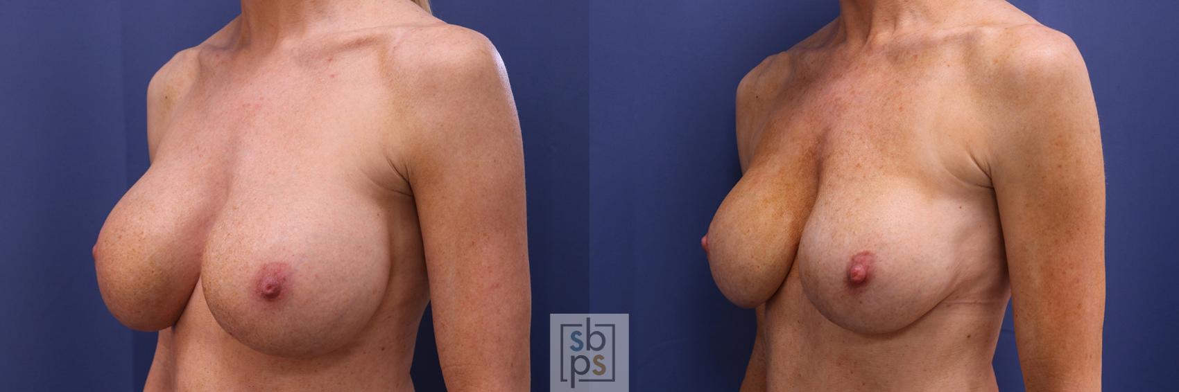 Before & After Breast Augmentation Case 355 View #3 View in Torrance & Los Angeles, CA, CA