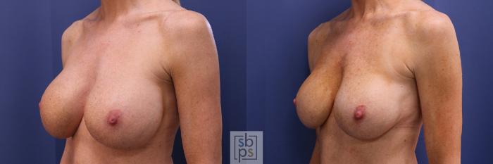 Before & After Breast Augmentation Case 355 View #3 View in Torrance, CA