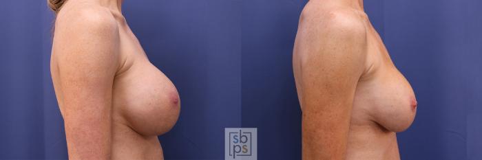 Before & After Breast Augmentation Case 355 View #4 View in Torrance, CA