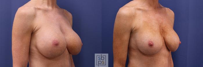 Before & After Breast Augmentation Case 355 View #5 View in Torrance, CA