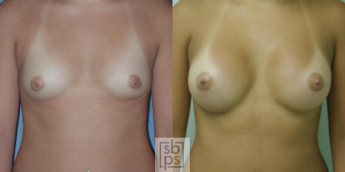 Before & After Breast Augmentation Case 36 View #1 View in Torrance, CA