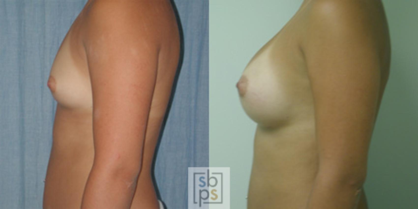 Before & After Breast Augmentation Case 36 View #2 View in Torrance & Los Angeles, CA, CA
