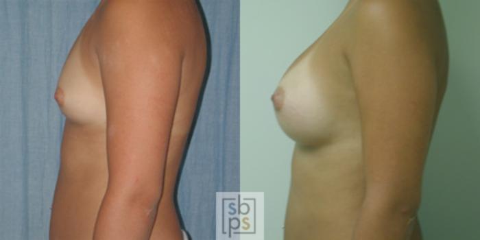 Before & After Breast Augmentation Case 36 View #2 View in Torrance, CA