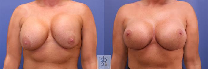 Before & After Breast Augmentation Case 364 View #1 View in Torrance, CA