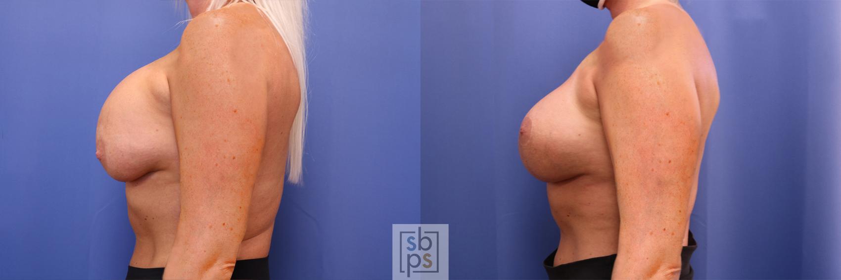 Before & After Breast Augmentation Case 364 View #2 View in Torrance & Los Angeles, CA, CA