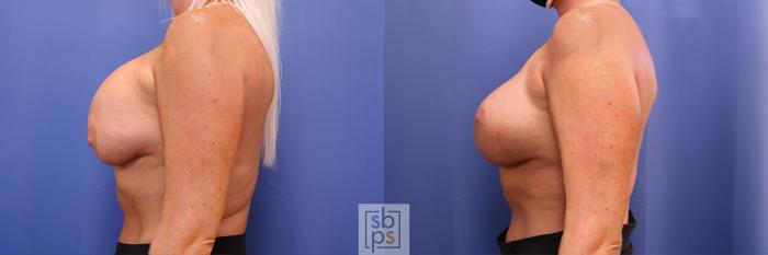 Before & After Breast Augmentation Case 364 View #2 View in Torrance, CA