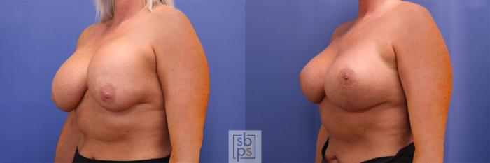 Before & After Breast Augmentation Case 364 View #3 View in Torrance, CA
