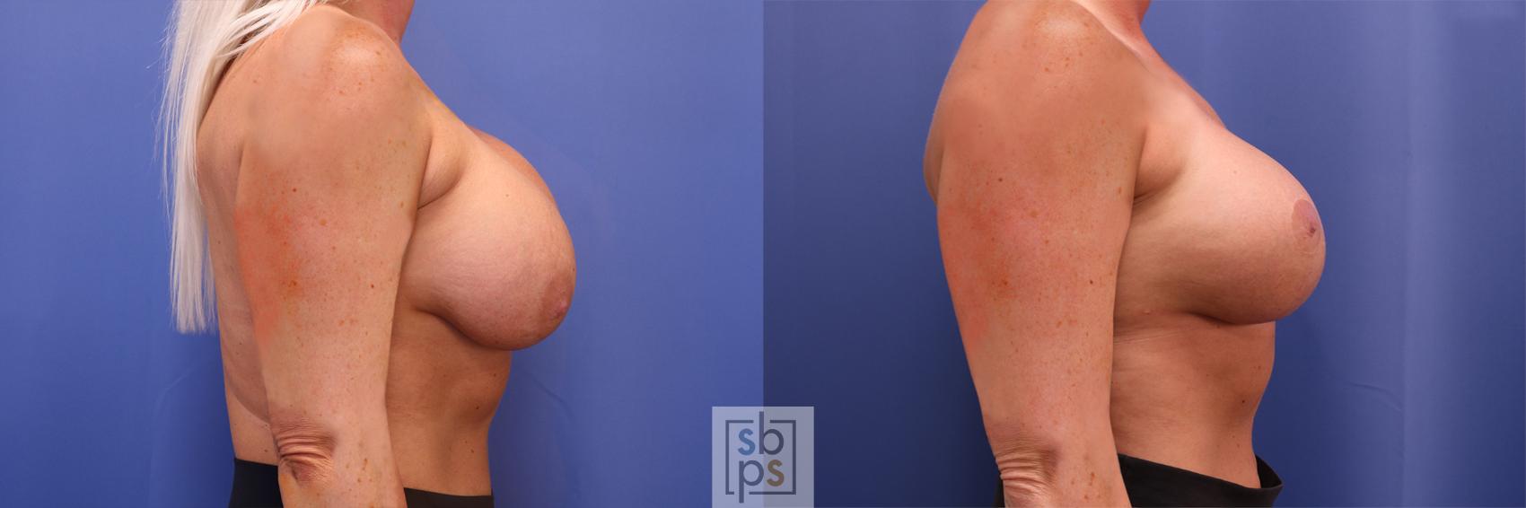 Before & After Breast Augmentation Case 364 View #4 View in Torrance & Los Angeles, CA, CA