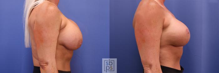Before & After Breast Augmentation Case 364 View #4 View in Torrance, CA