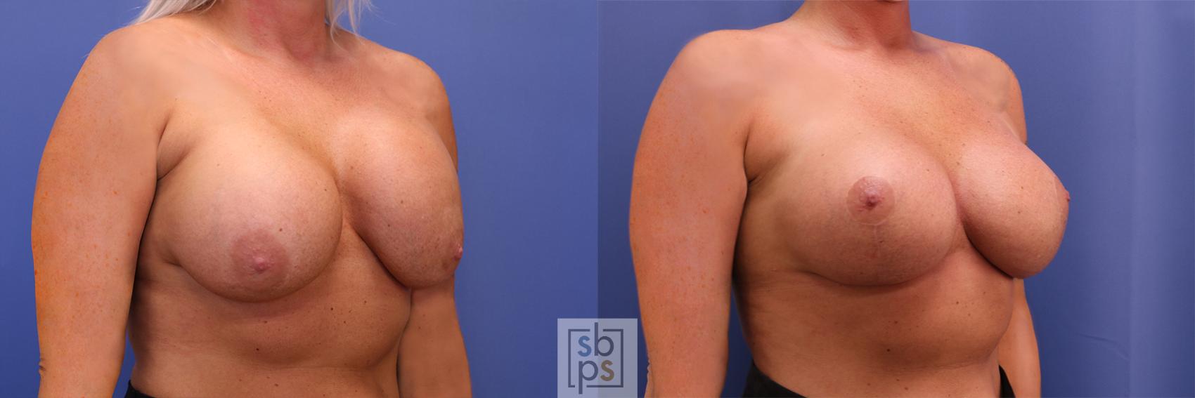 Before & After Breast Augmentation Case 364 View #5 View in Torrance & Los Angeles, CA, CA