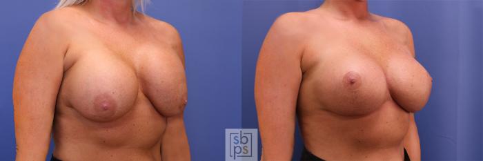 Before & After Breast Augmentation Case 364 View #5 View in Torrance, CA