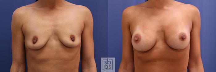 Before & After Breast Augmentation Case 366 View #1 View in Torrance, CA