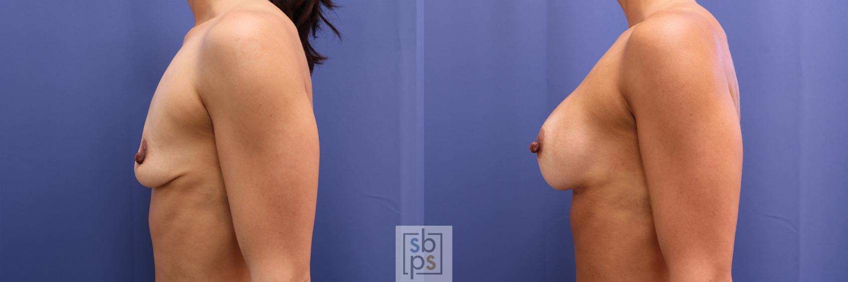Before & After Breast Augmentation Case 366 View #2 View in Los Angeles, Torrance & Long Beach, CA