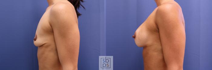 Before & After Breast Augmentation Case 366 View #2 View in Torrance, CA