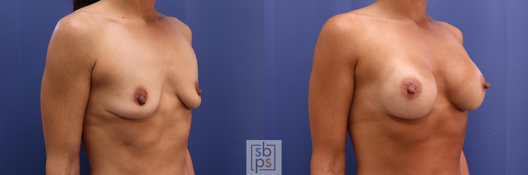 Before & After Breast Augmentation Case 366 View #4 View in Los Angeles, Torrance & Long Beach, CA