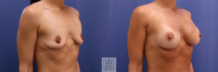 Before & After Breast Augmentation Case 366 View #4 View in Torrance, CA
