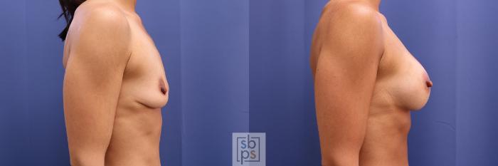 Before & After Breast Augmentation Case 366 View #5 View in Torrance, CA