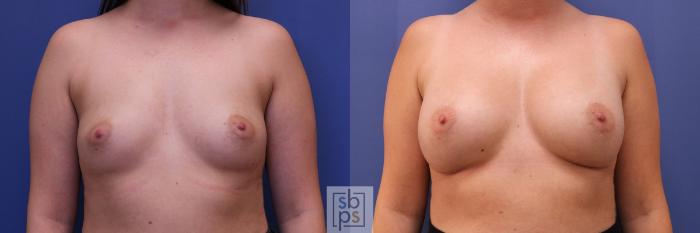 Before & After Breast Augmentation Case 367 View #1 View in Torrance, CA