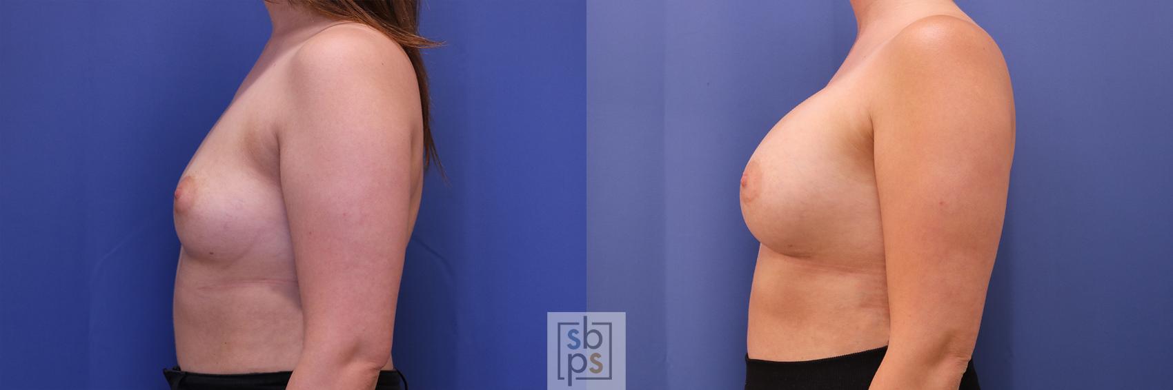 Before & After Breast Augmentation Case 367 View #2 View in Torrance & Los Angeles, CA, CA