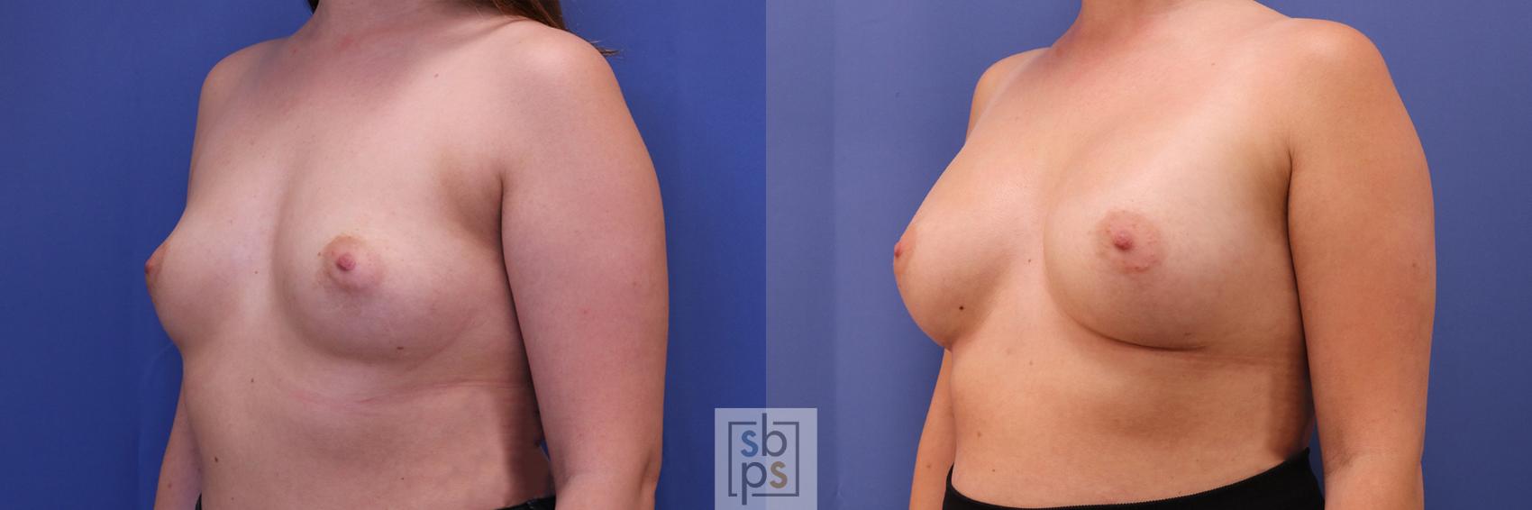 Before & After Breast Augmentation Case 367 View #3 View in Torrance & Los Angeles, CA, CA