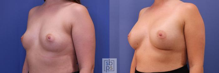 Before & After Breast Augmentation Case 367 View #3 View in Torrance, CA