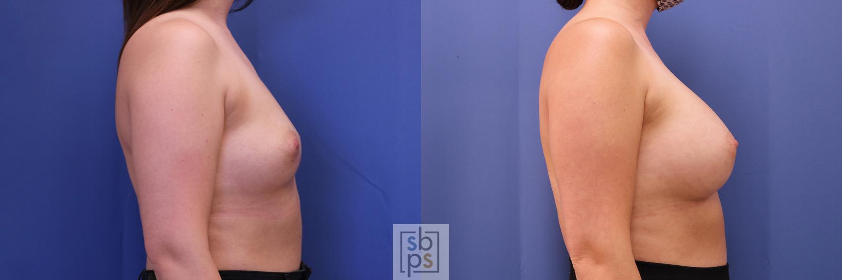 Before & After Breast Augmentation Case 367 View #4 View in Torrance & Los Angeles, CA, CA