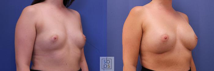 Before & After Breast Augmentation Case 367 View #5 View in Torrance, CA