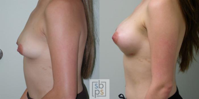 Before & After Breast Augmentation Case 37 View #2 View in Torrance, CA