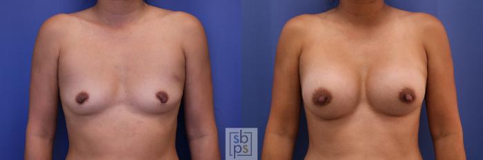 Before & After Breast Augmentation Case 378 View #1 View in Torrance, CA
