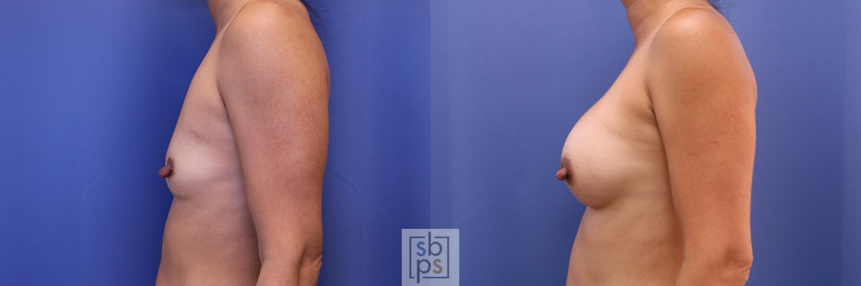 Before & After Breast Augmentation Case 378 View #2 View in Torrance & Los Angeles, CA, CA