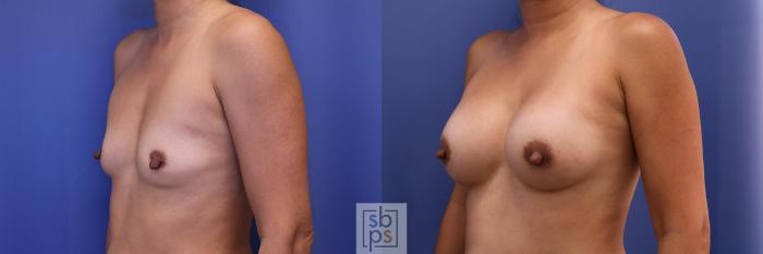 Before & After Breast Augmentation Case 378 View #3 View in Torrance, CA