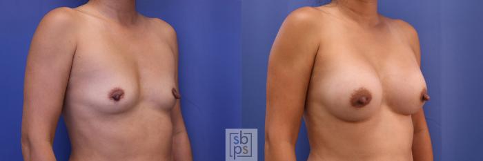 Before & After Breast Augmentation Case 378 View #5 View in Torrance, CA