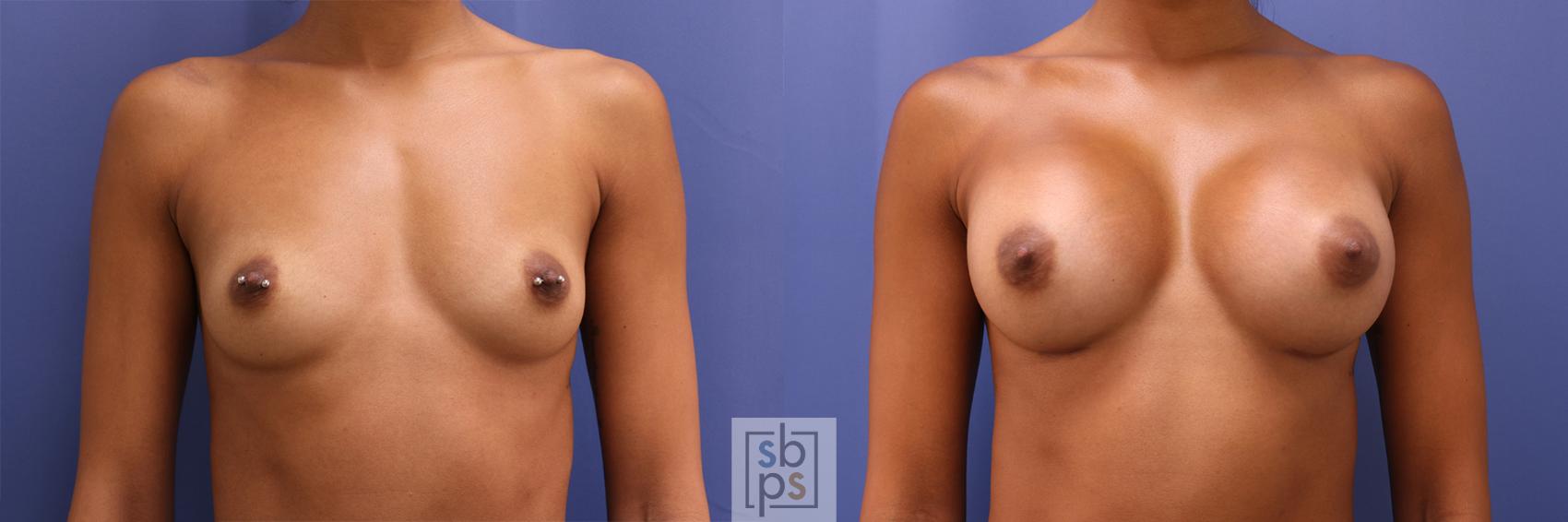 Before & After Breast Augmentation Case 381 View #1 View in Torrance, CA