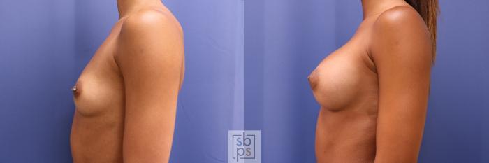 Before & After Breast Augmentation Case 381 View #2 View in Torrance, CA