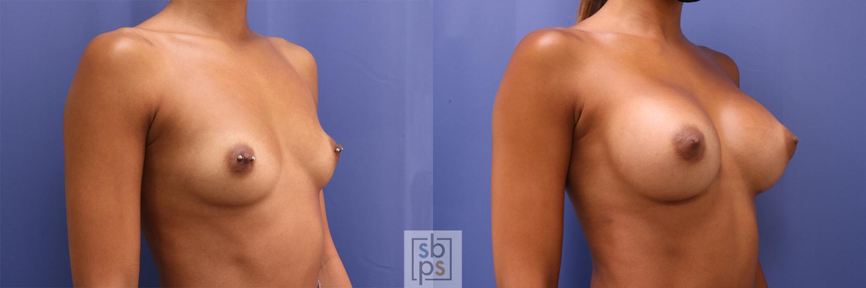 Before & After Breast Augmentation Case 381 View #5 View in Torrance & Los Angeles, CA, CA