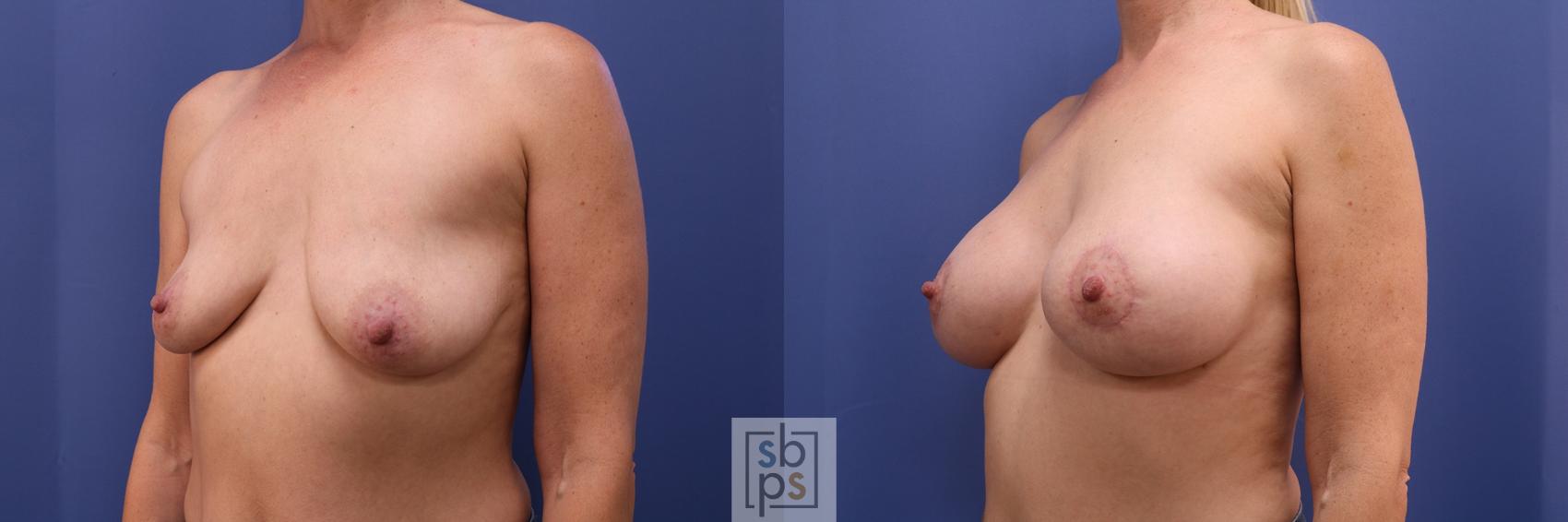 Before & After Breast Lift Case 383 Left Oblique View in Torrance & Los Angeles, CA, CA