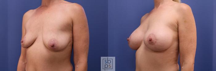 Before & After Breast Augmentation Case 383 Left Oblique View in Torrance, CA